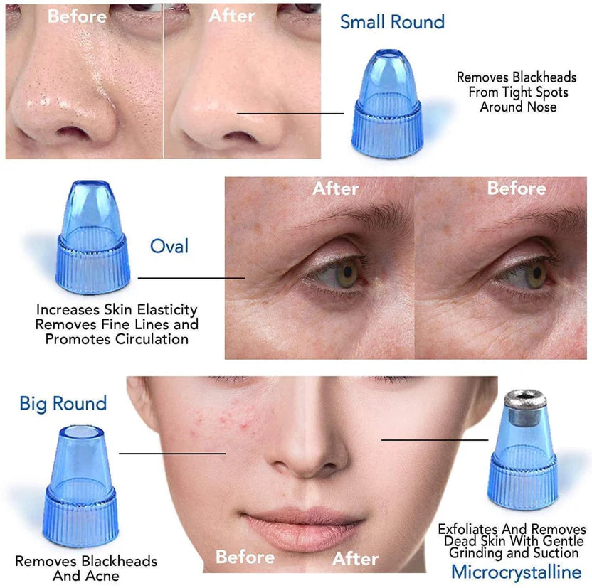 Derma Suction Pore Cleaning Device With Vacuum Action Face Pore